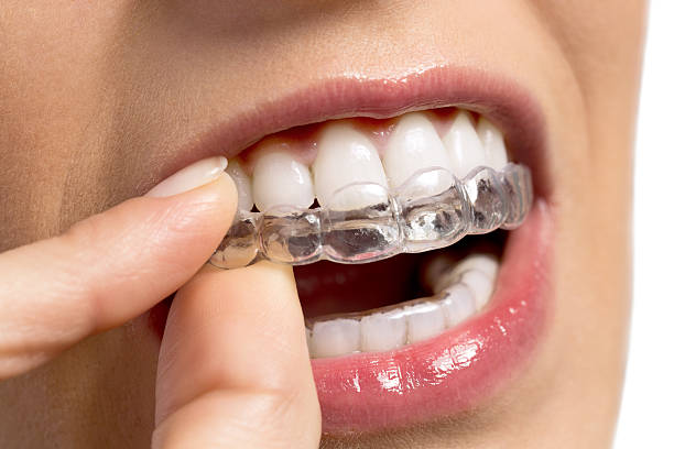 Invisalign treatment - Steps and its benefits : evergreenortho — LiveJournal