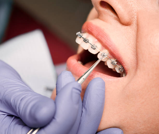 Teeth alignment treatment with braces in Mableton – Evergreenorthoga