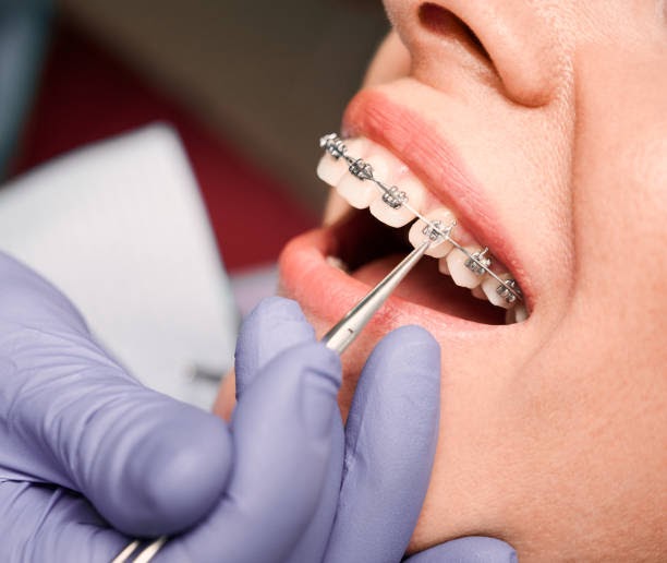 Teeth alignment treatment with braces in Mableton