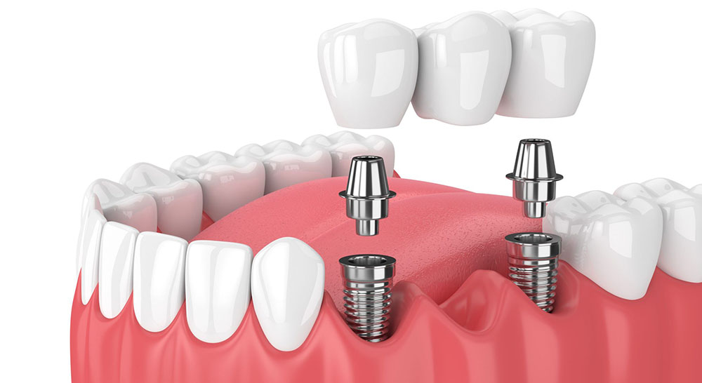 Dental Implants in Gurgaon | Cost of Dental Implants in Gurgaon