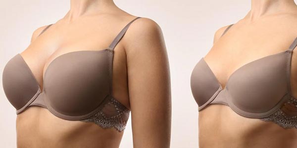 Breast reduction Nova Scotia