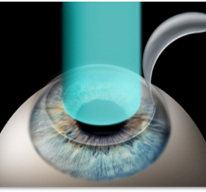 Best Lasik Eye Surgery In Delhi, Best Eye Laser Treatment In Delhi | Vision Eye Centre