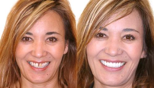 Cosmetic Smile Makeover in Manhattan | Upper West Side Dental