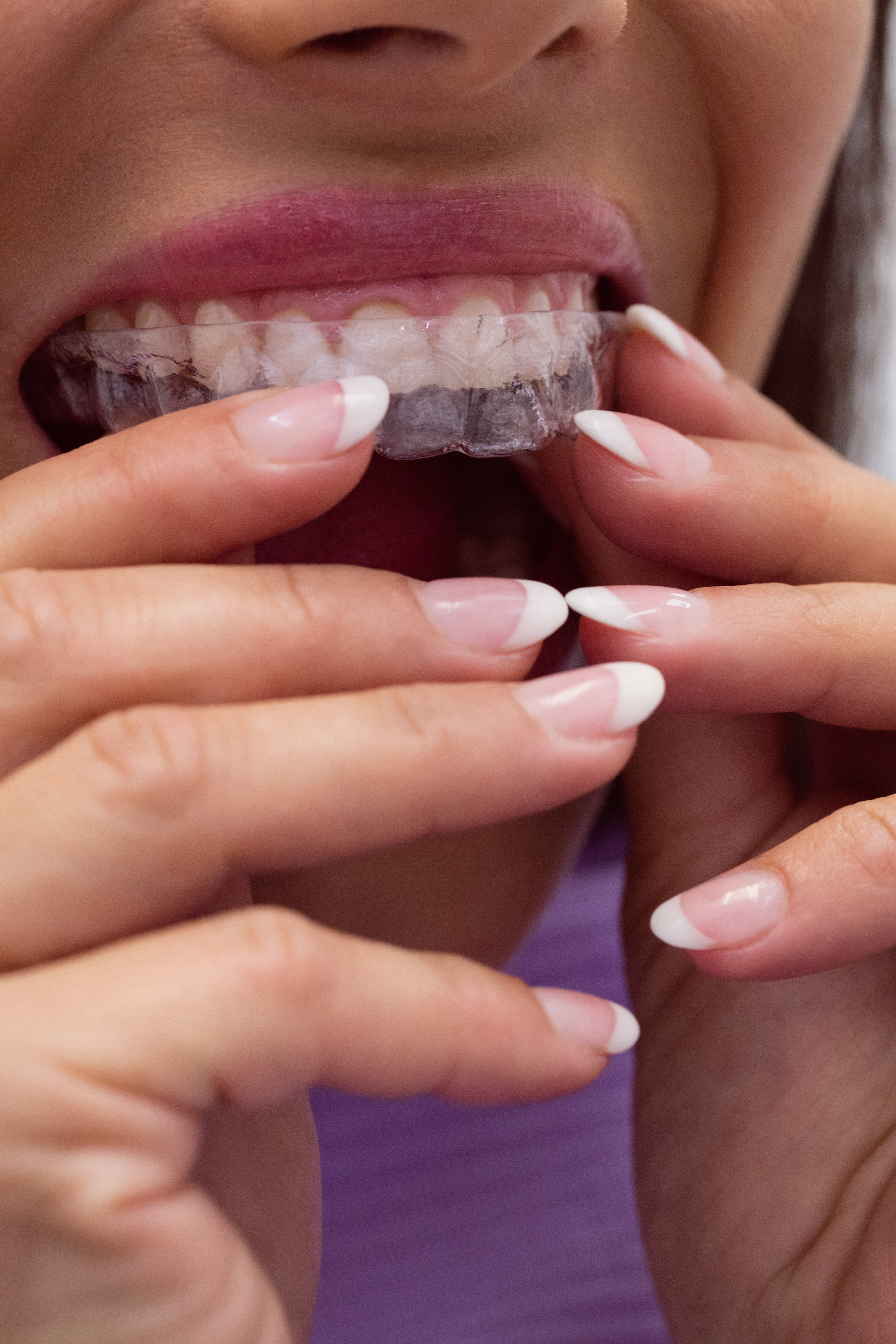 Transform Your Smile with Invisalign Braces, Cosmetic Dental Crowns, and Bonding Veneers – Eternal Smiles Dental Centre