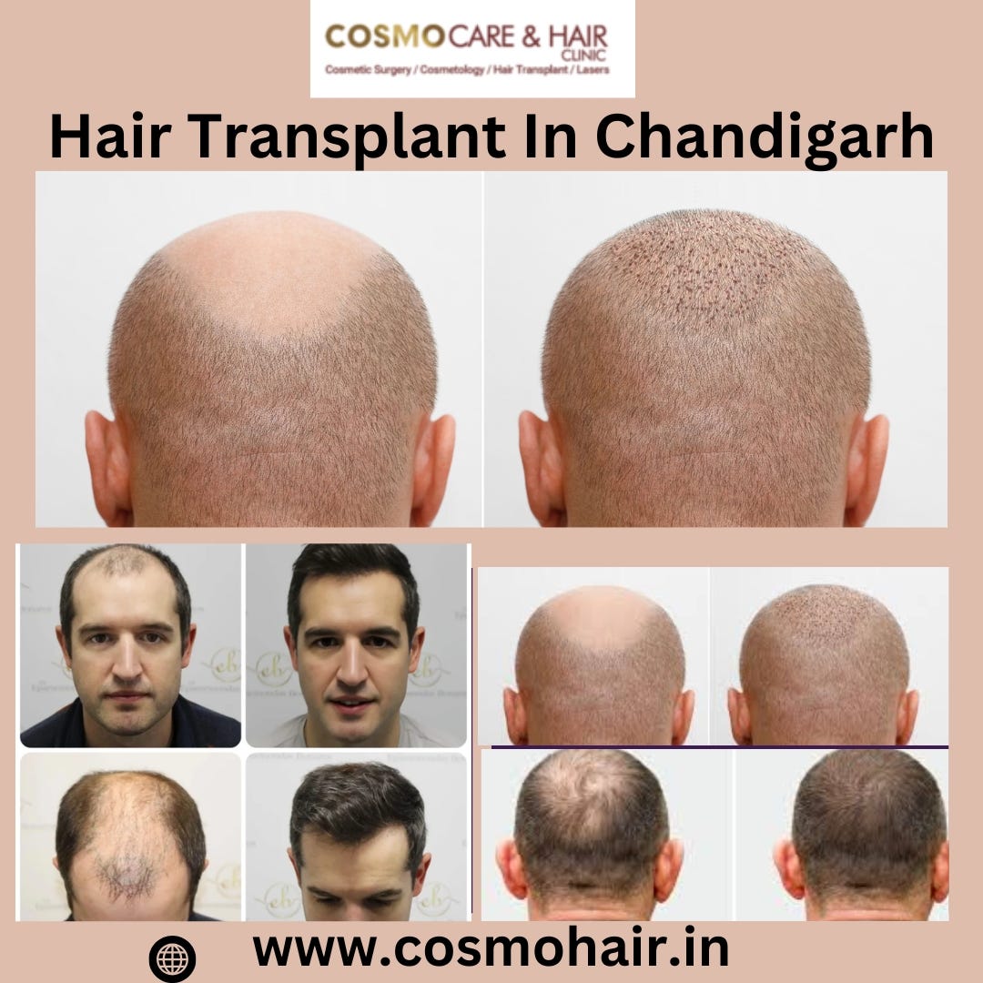 How to Choose the Best Hair Transplant Clinic in Chandigarh | by Cosmo Care & Hair Clinic | Mar, 2025 | Medium