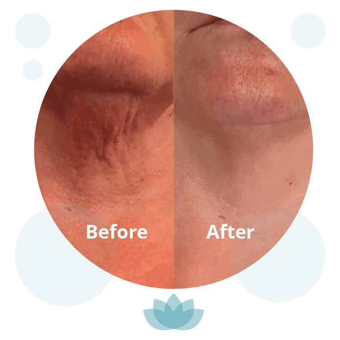 Profhilo treatment price UK and guide to availing its benefits
