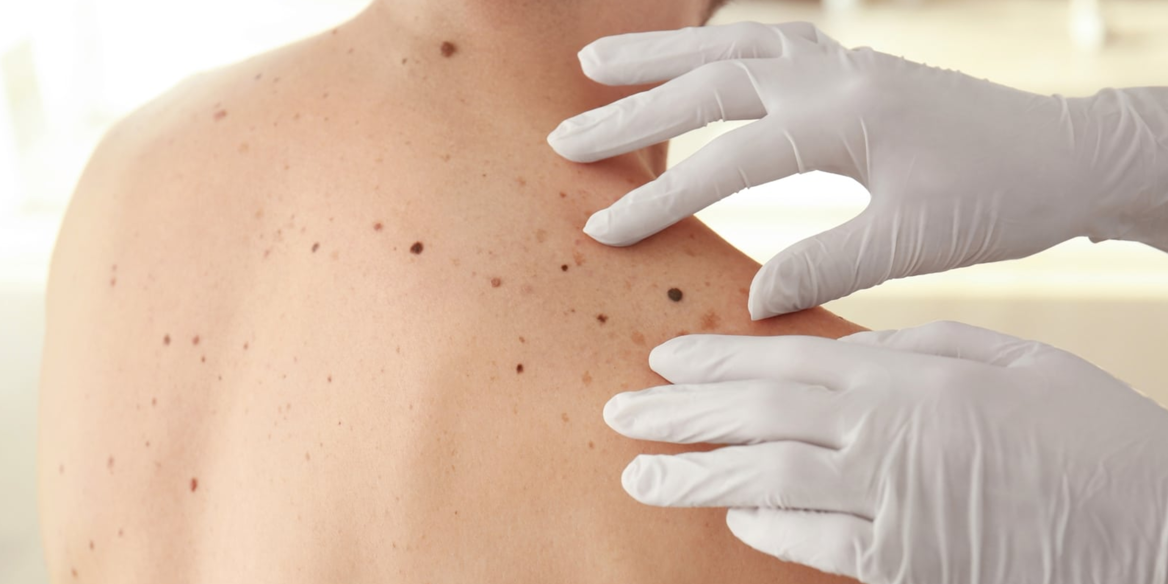 When to Worry About a Mole: Signs of Skin Cancer You Should Not Neglect | Dermatology Clinic in Nelson – Site Title