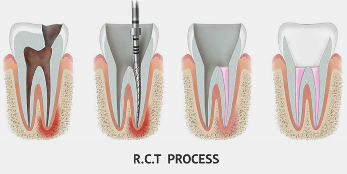 Root Canal Treatment in Noida | Shavi Dental Care – Gentle RCT