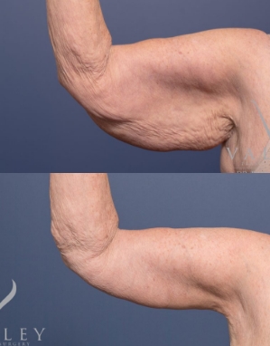 Brachioplasty Brisbane - Arm Lift Surgery - Dr Raymond Goh