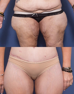 Thigh Lift Surgeon in Brisbane - Thighplasty - Dr Ray Goh