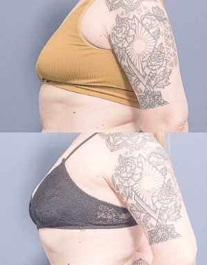 Back Bra Lift Surgeon in Brisbane - Dr Raymond Goh