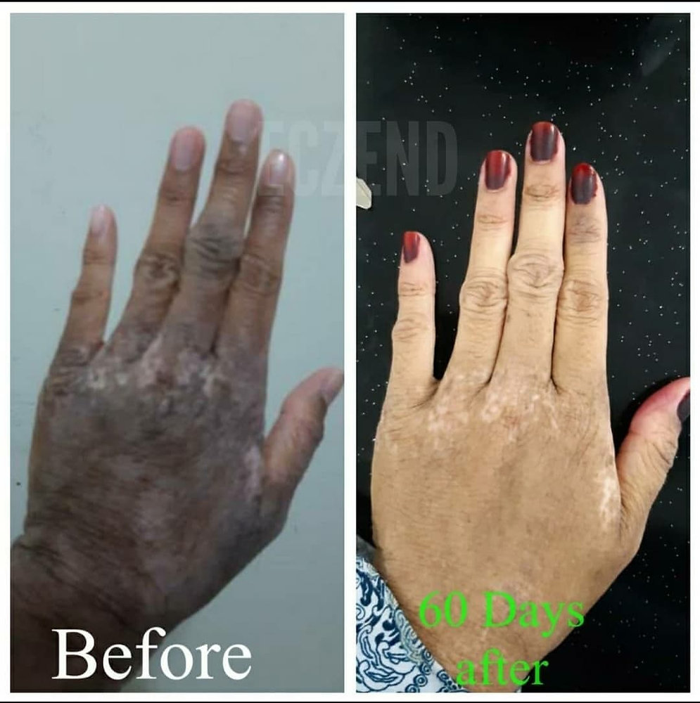 How to Cure Itching Flaky Dry Skin | Stop Itching Completely